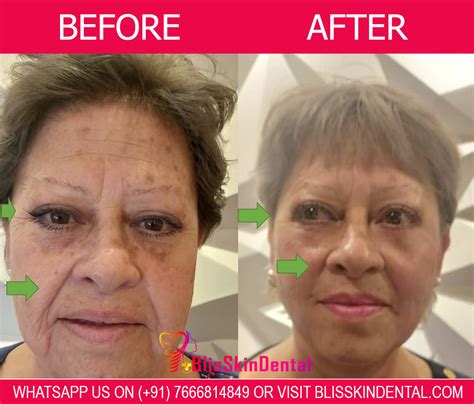 High-intensity focused ultrasound treatment (HIFU) in Mumbai - Bliss ...