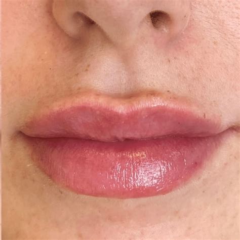 Bump On Upper Lip
