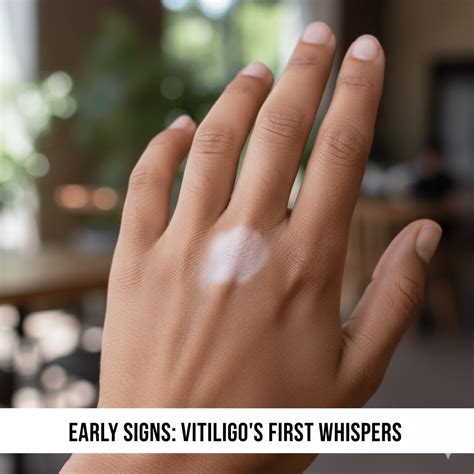 First Signs of Vitiligo: How to Identify Skin Changes Early - Vitiligoo