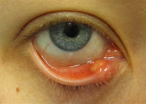 Yellow Pimple Inside Eyelid