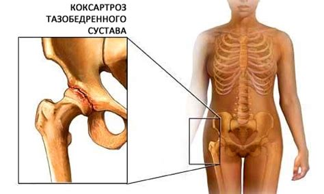 Гимнастика при коксартрозе тазобедренного сустава 1,2 и 3 степени