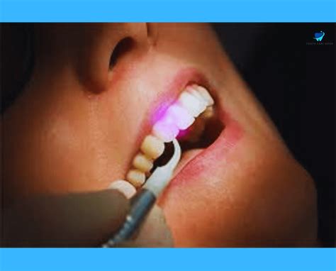 What Is Laser Teeth Cleaning? | A Comprehensive Guide