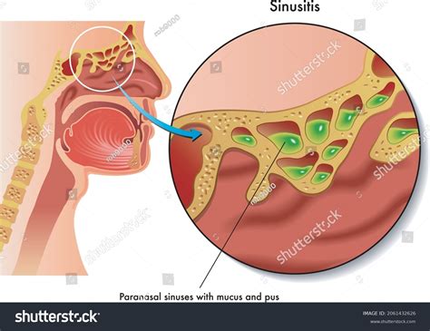 Purulent Nasal Drainage