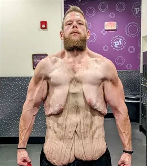 I have so much loose skin after losing 360 pounds