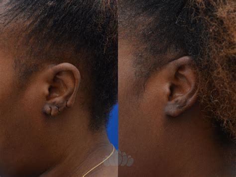 Earlobe Repair Before and After Pictures Case 86 | Charlotte, NC | Dilworth Facial Plastic Surgery
