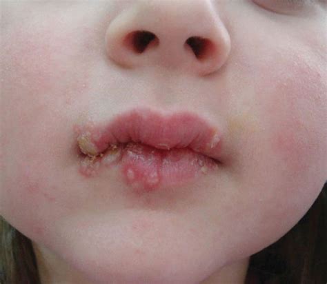 Rash Around Child's Mouth