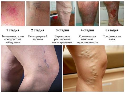 Стадии варикоза нижних конечностей — симптомы и лечение по этапам