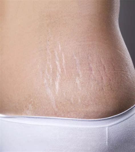 Tighten Belly Skin After Pregnancy: 10 Effective Tips