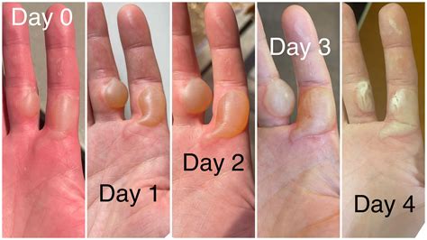 How To Treat A Burn Blister On Foot at Katina Woods blog