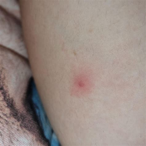 painful pimples on legs, they are full of white and are very red around. Very painful : r ...
