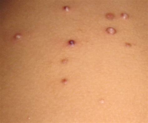 Cures For Molluscum Contagiosum Top 5 Home Remedies For Molluscum | Molluscum Contagiosum Home ...