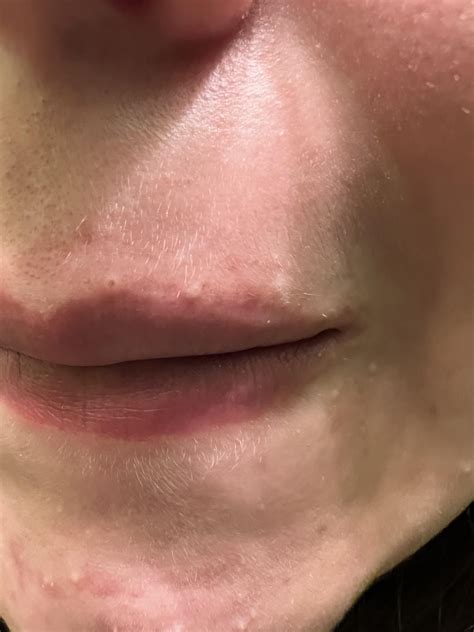 What are these white bumps on my chin?? They can be popped but always come back. Also how to ...