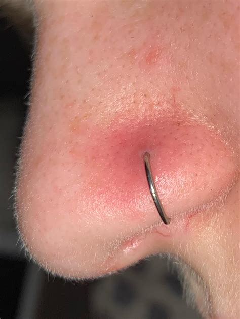 Infected Nostril Piercing
