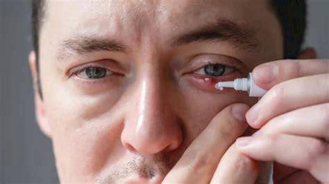 Chalazion Healing Stages - PEL