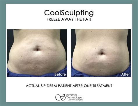 Does Coolsculpting Work