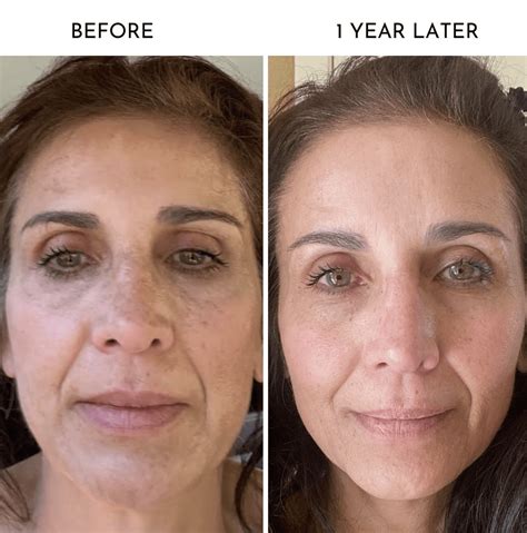 Microneedling Before and After: Your Ultimate Beauty Transformation