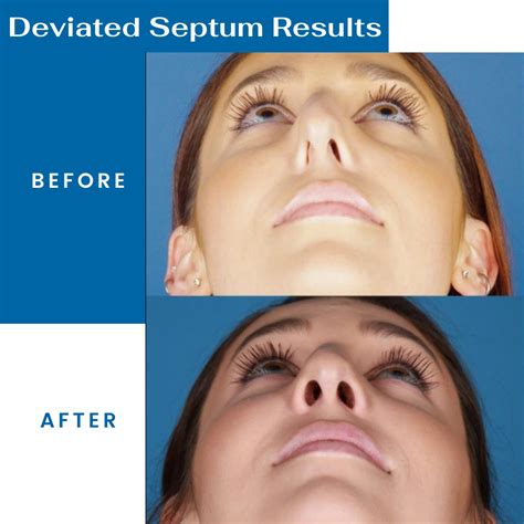 Deviated Septum Surgery Recovery