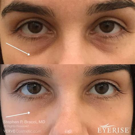 Puffy eyes dark circles and bags dermatologists explain the difference – Artofit