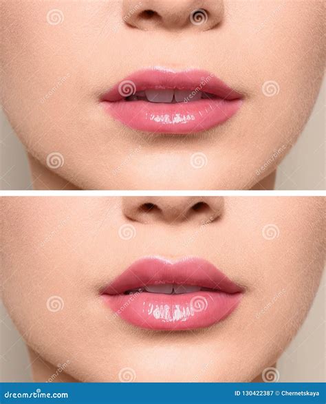 Woman before and after Lips Augmentation Procedure, Stock Image - Image of female, medicine ...