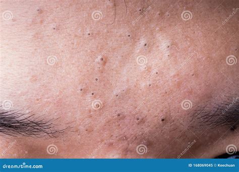 Blackhead Forehead