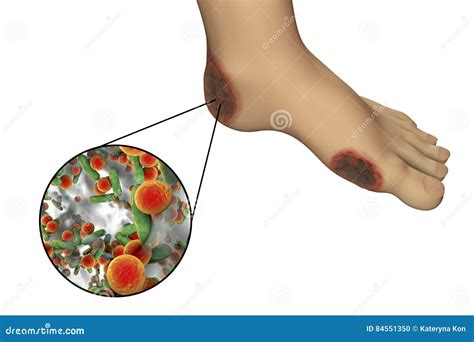 Diabetic Foot Infection with Close-up View of Bacteria Stock ...