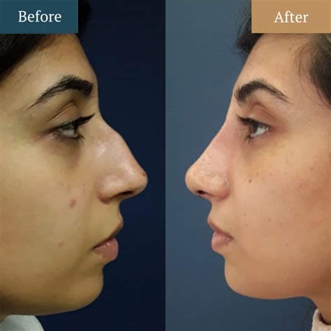 How Much is a Nose Job (Rhinoplasty) in the UK? - Harley Medical Group