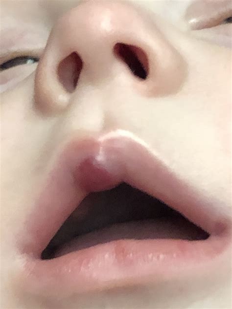 Strawberry Hemangioma Lip