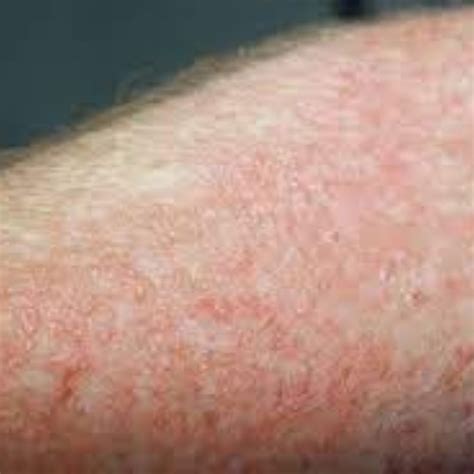 Understanding Contact Dermatitis: Symptoms, Causes, and