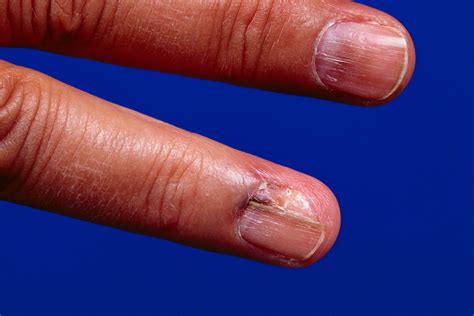 5 Symptoms of Skin Cancer in Your Nails That Are Easy to Miss | SELF
