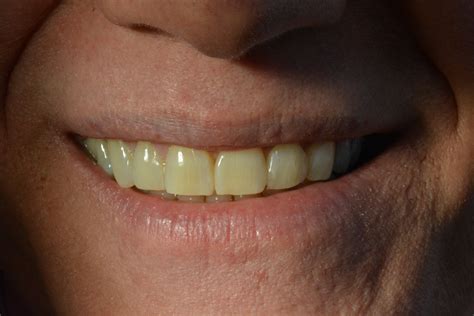 Teeth Bonding Gap Before And After at Matthew Driscoll blog