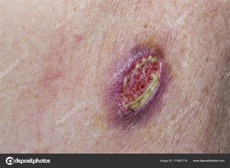 Wound Dehiscence Scar at Ellie Ridley blog