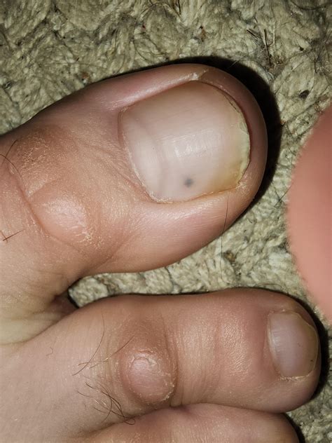 Had this tiny dark spot pop up under my toenail. What could this be? : r/Melanoma