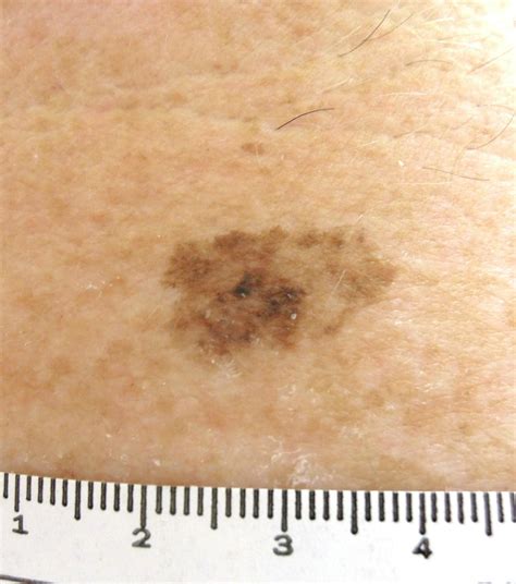 Melanoma Stages Nodular Melanoma: Blood Blister, Symptoms, Causes
