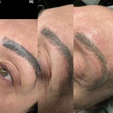 Laser Hair Removal Eyebrows