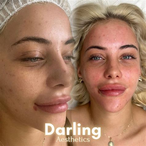 Darling Aesthetics | Forest Hall | Newcastle (@darlingaestheticsclinic ...