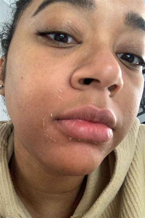 Skin Peeling In Mouth
