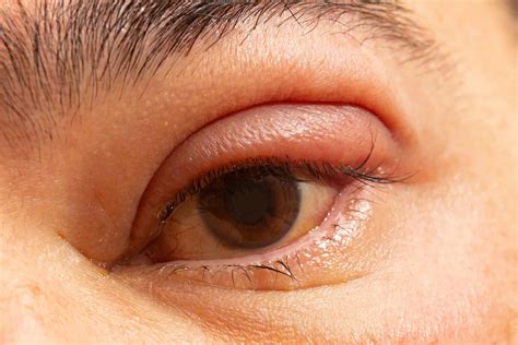How To Stop Recurrent Eyelid Inflammation at Christian Brown blog