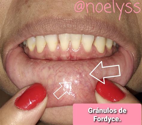 🤔 Fordyce granules and how can they be confused with pathologies ...