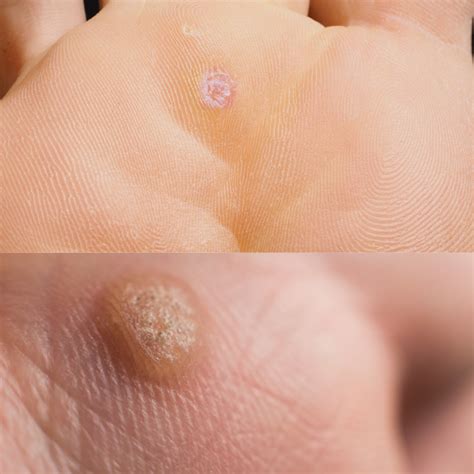 Corn Vs Wart Foot at Eileen Marvin blog