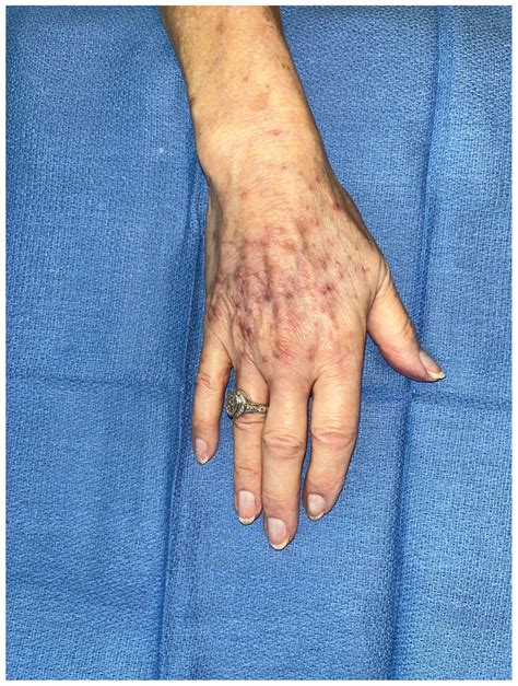 Phlegmasia cerulea dolens of the upper extremity treated with anticoagulation and leech therapy ...