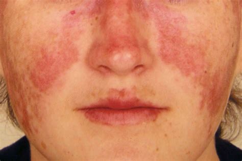 Lupus Life Expectancy, Prognosis, and Risks