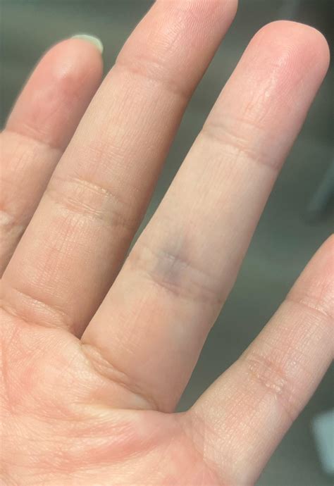 Burst Blood Vessel In Finger Images Blood Blisters: Causes, Diagnosis,