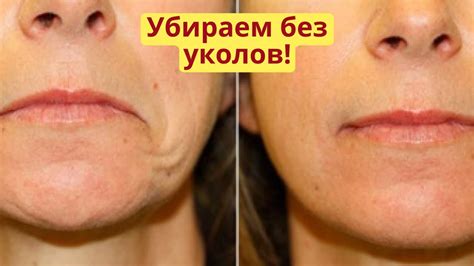 Опущенные уголки губ, морщины марионетки, кисетные морщины и носогубная ...