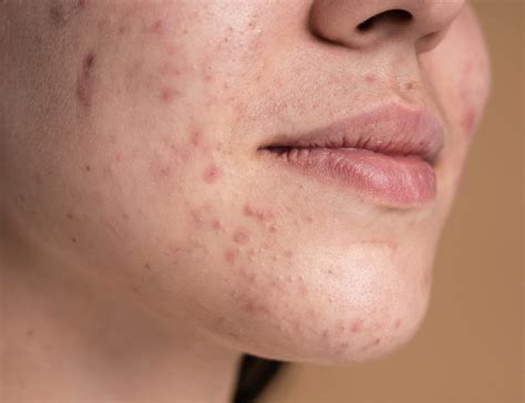 Does Eating Greasy Food Cause Acne Breakout? - Radium Wellness