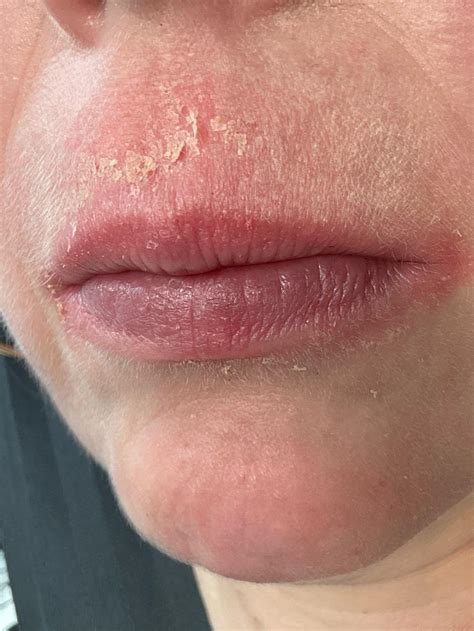 Eczema Around Mouth