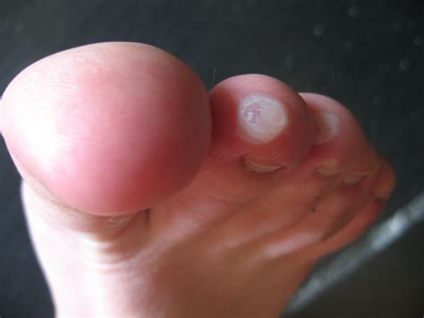 Pointe Shoe Blisters