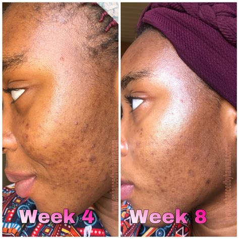 Urban Skin Rx Retinol Dark Spot Treatment - Enhanced By Hawwa