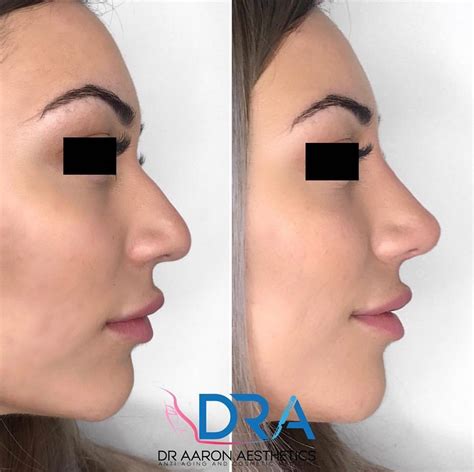 Non-Surgical Rhinoplasty Purpose: To hide bumps, straighten your nose, build a nose bridge or ...