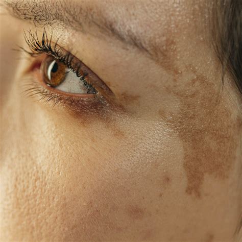 Pigmentation & Uneven Skin Tone