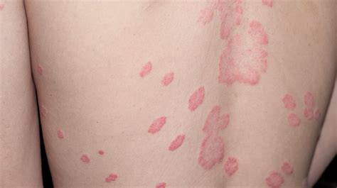 WHAT IS LICHEN SCLEROSUS: SYMPTOMS, CAUSES, DIAGNOSIS, AND MORE - Chiid Health